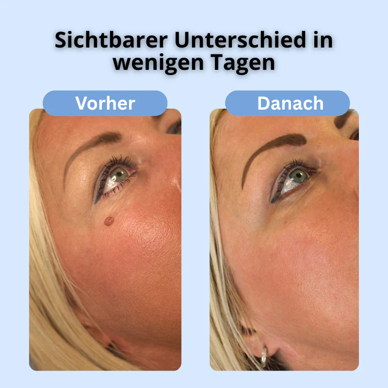 Dermalux™ | Nie wieder Hautanhängsel