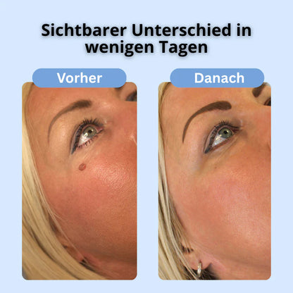 Dermalux™ | Nie wieder Hautanhängsel