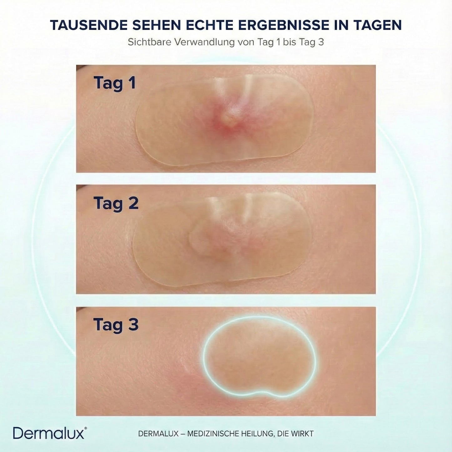 DermaTape™ | Pflaster gegen Narben und Akne