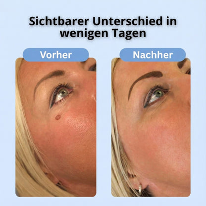 Dermalux™ | Nie wieder Hautanhängsel