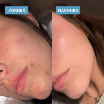 DermaTape™ | Pflaster gegen Narben und Akne