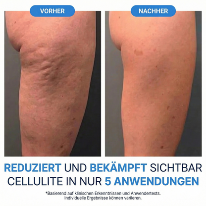 Dermalux® Cellulite Roller