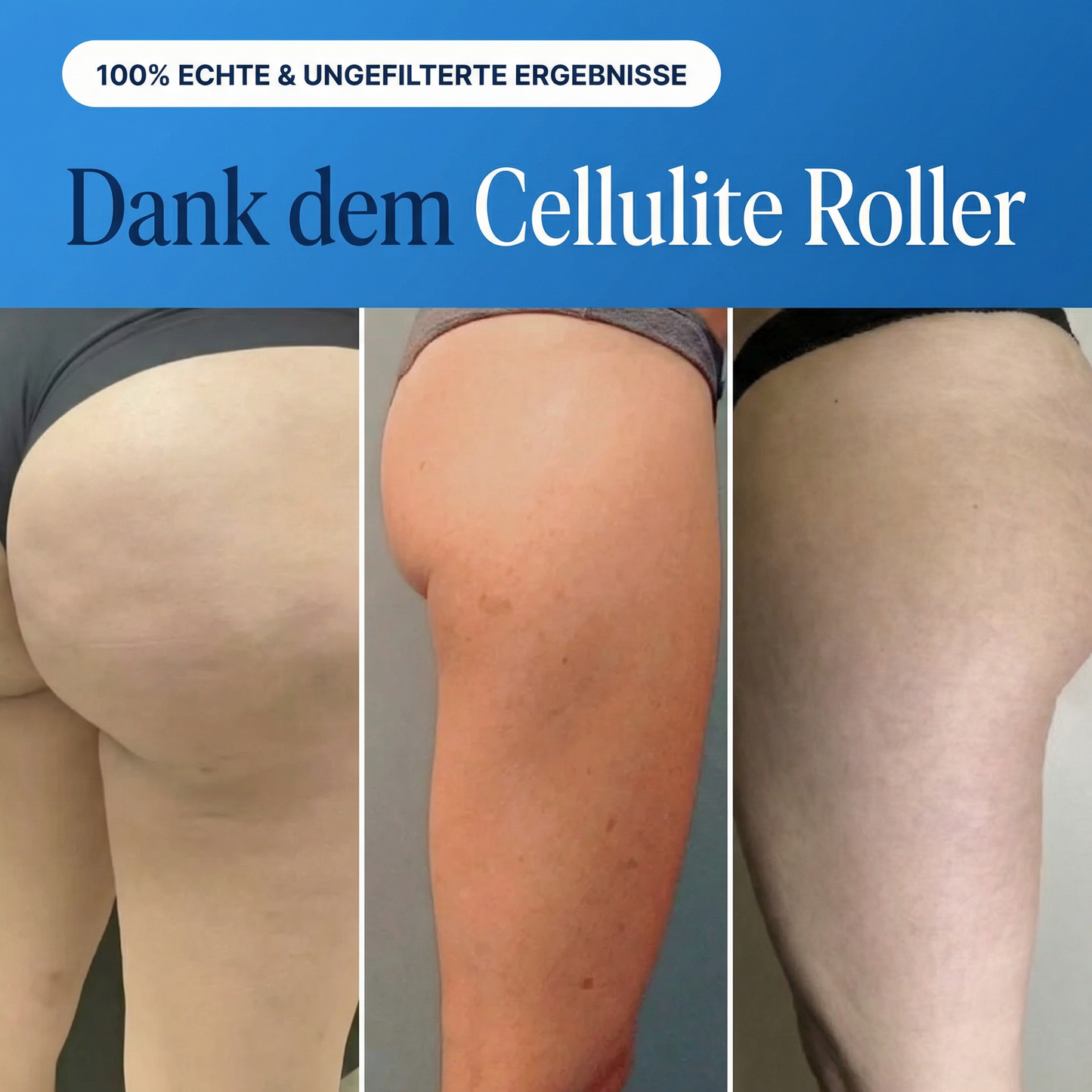 Dermalux® Cellulite Roller